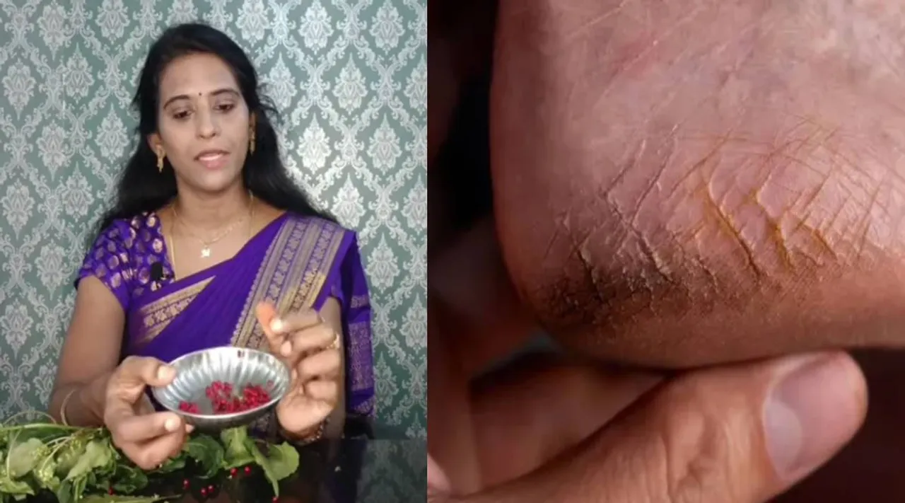 பாத வெடிப்பு 