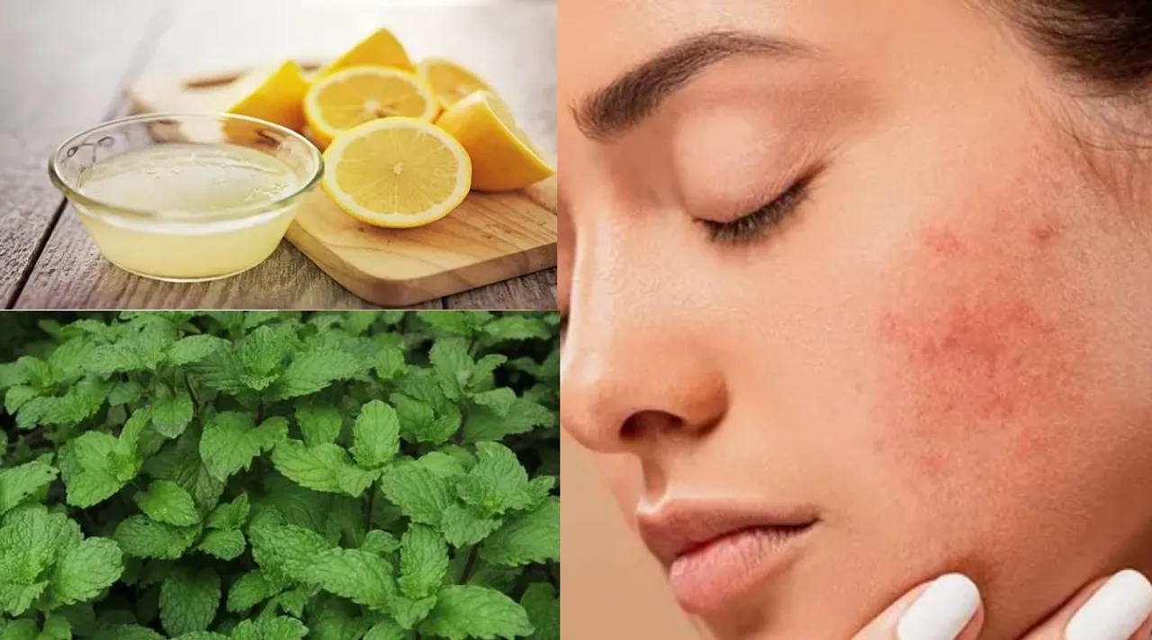 Pimple remedy