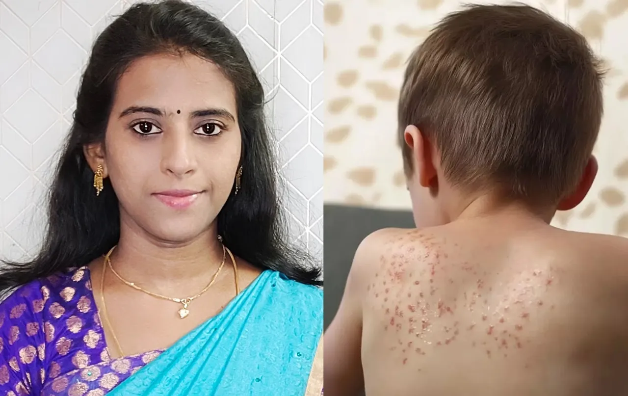 summer skin problems natural remedies