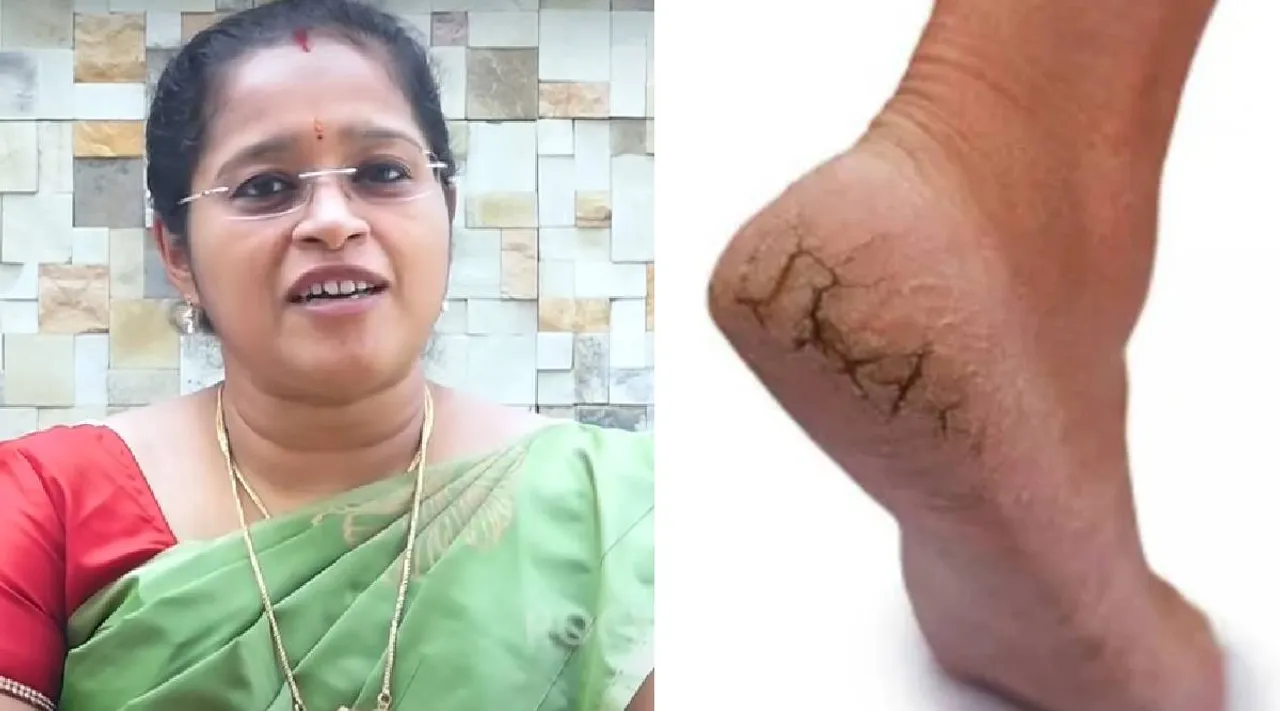 Cracked heels remedy
