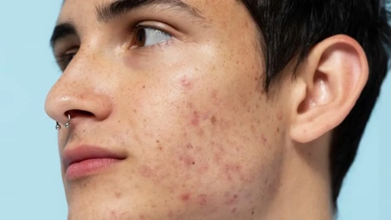 pimples
