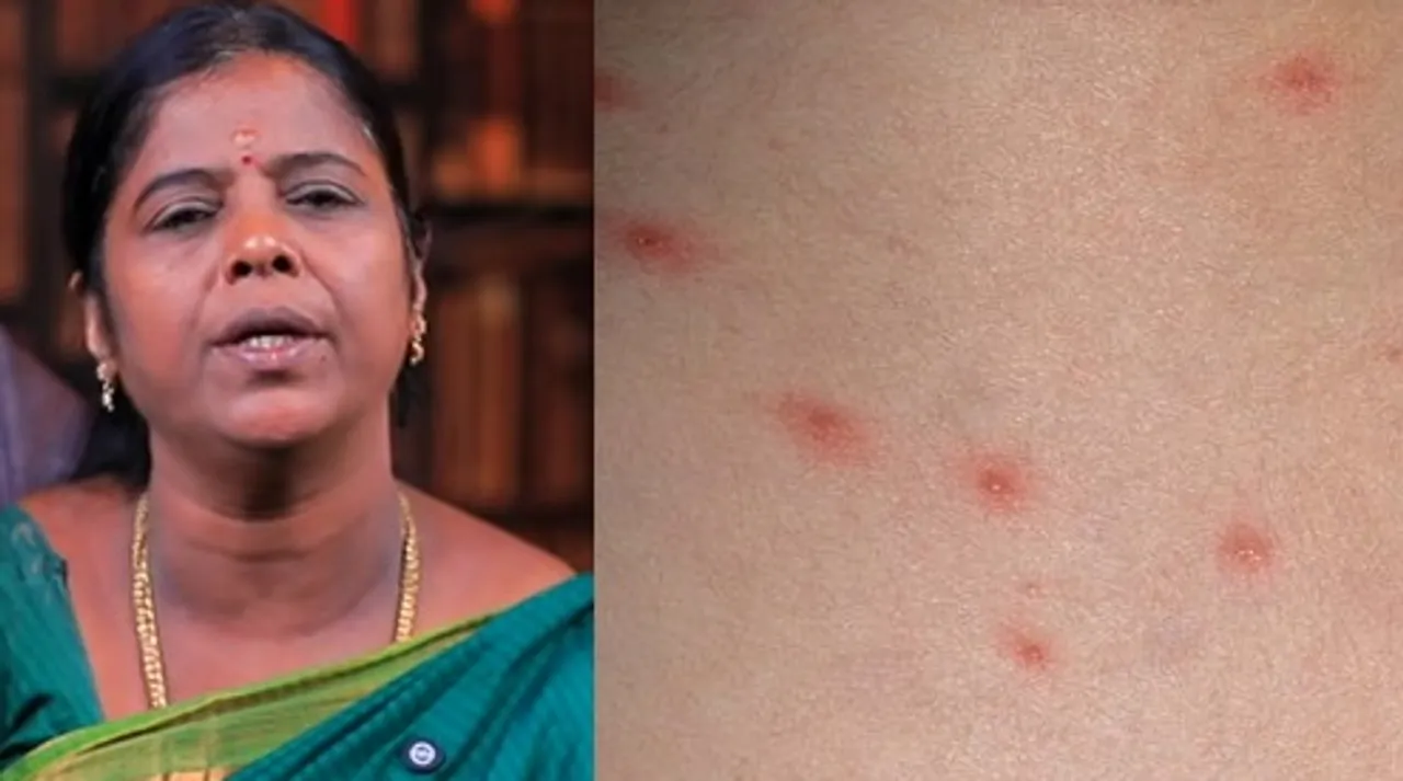 Chickenpox home remedy
