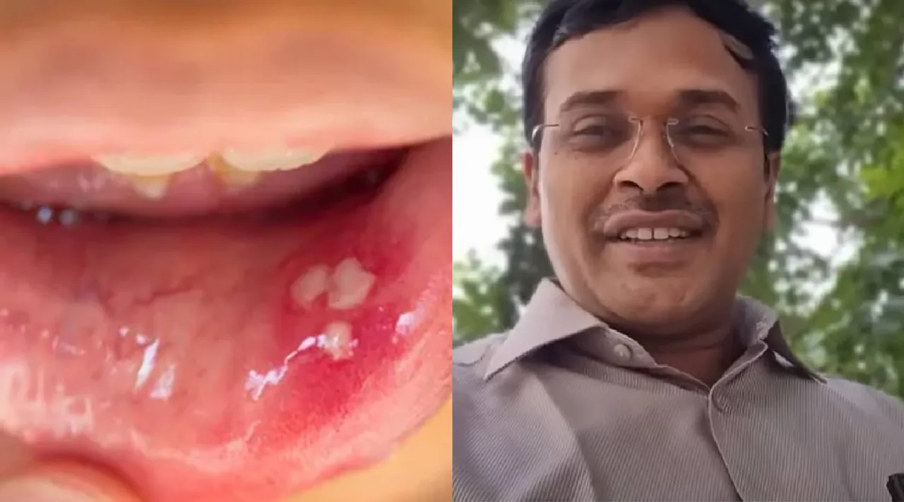 Mucocele