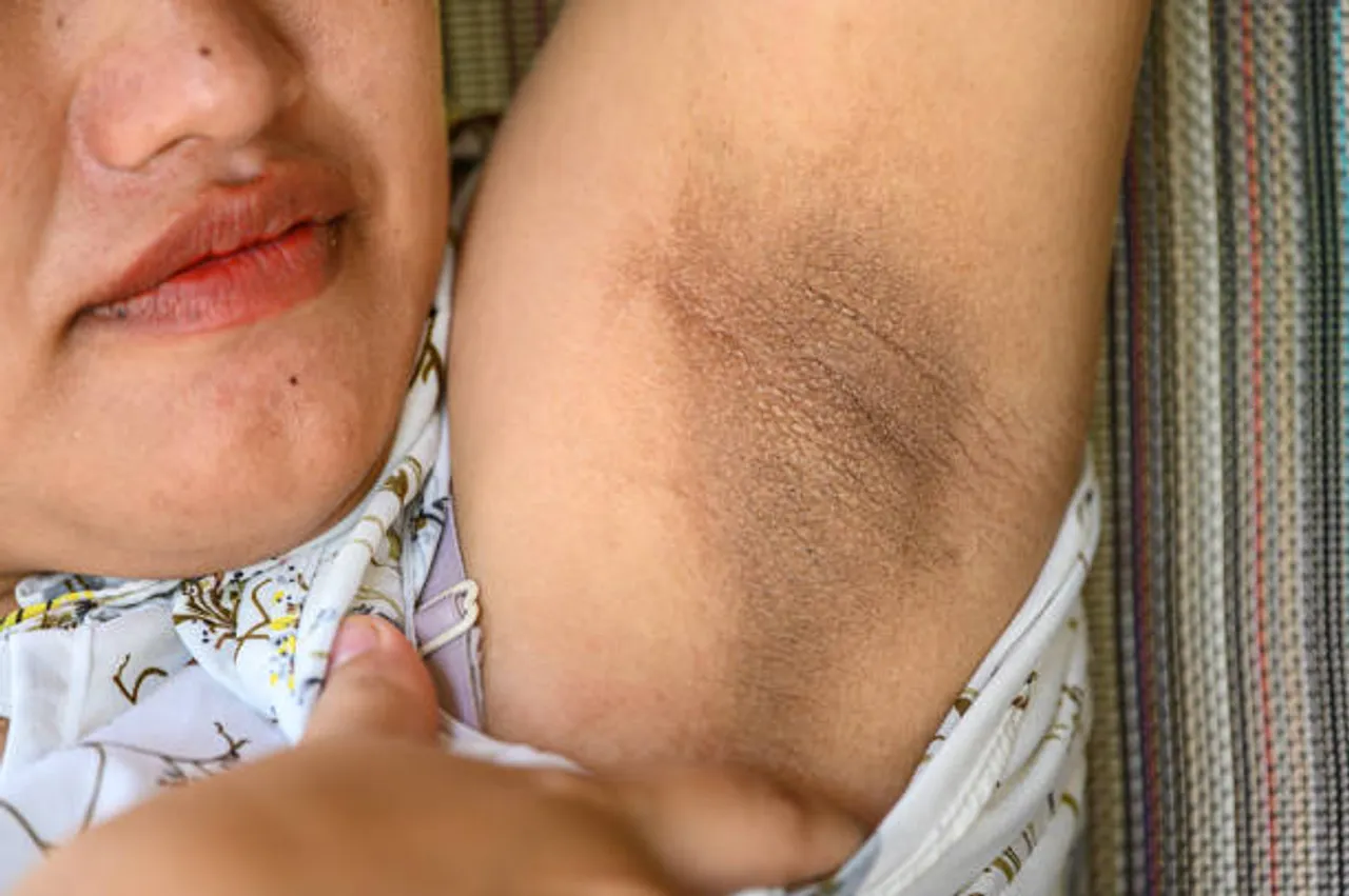 underarm darkness