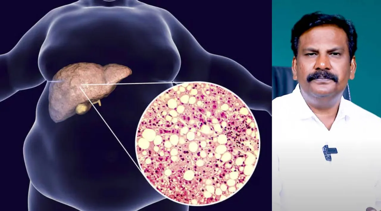 Fat that sticks to the liver.