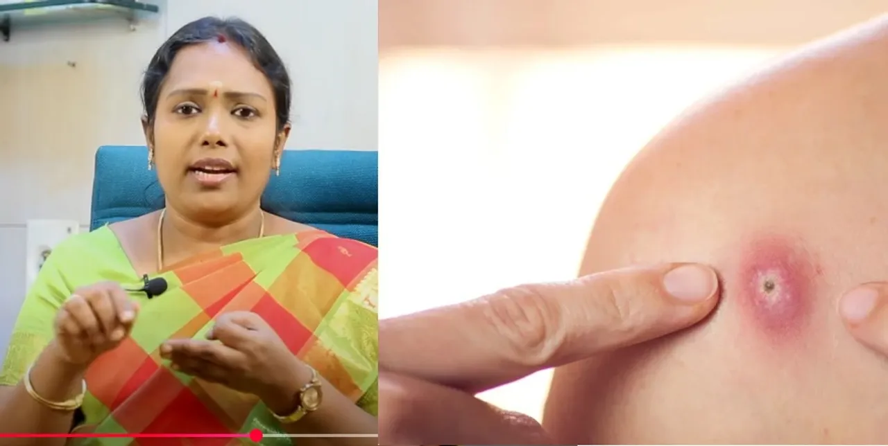 Summer heat boils home remedies