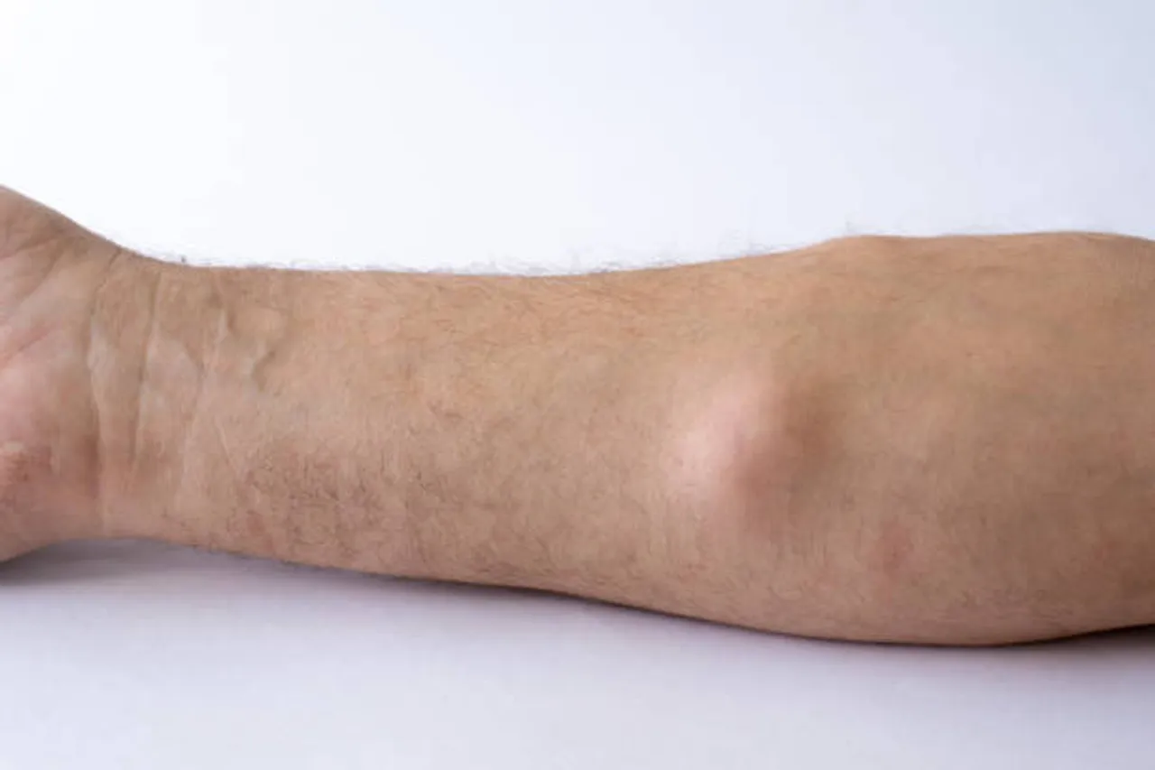 Lipoma