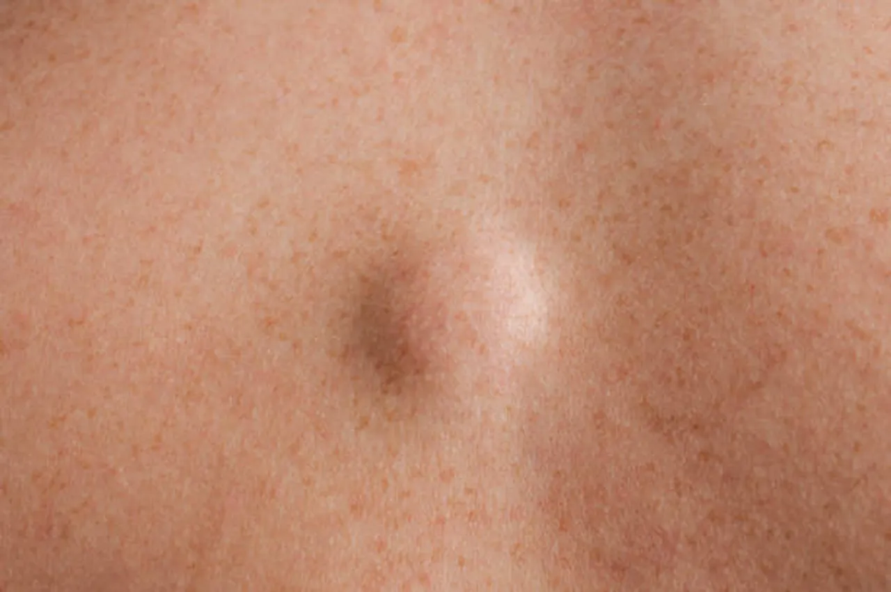 Lipoma