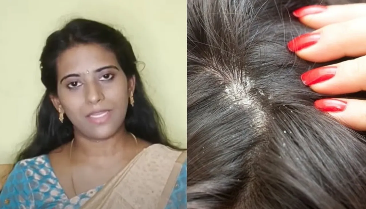 Dandruff hair mask
