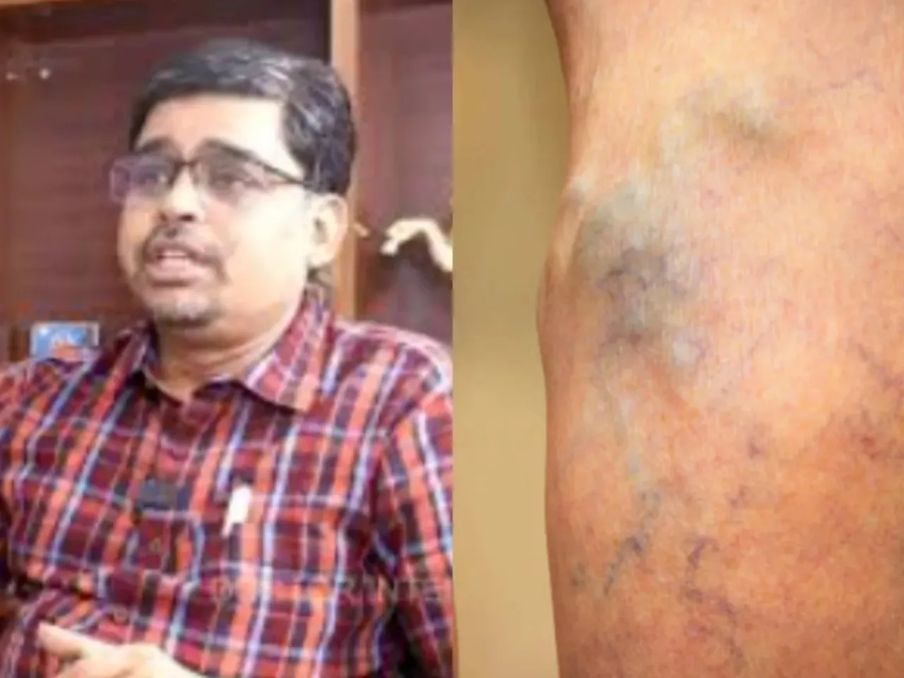 varicose veins