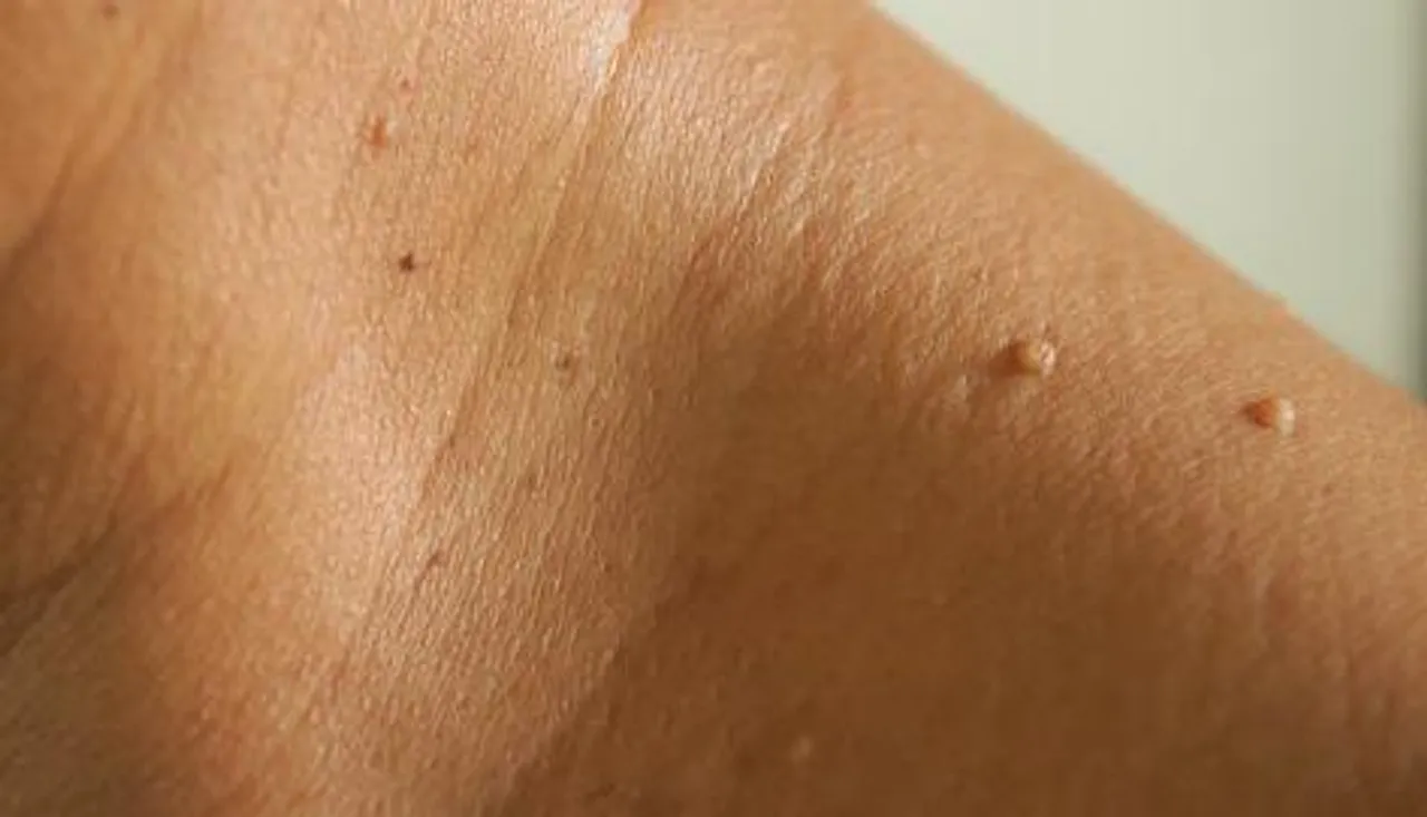 Skin tags moles causes treatment