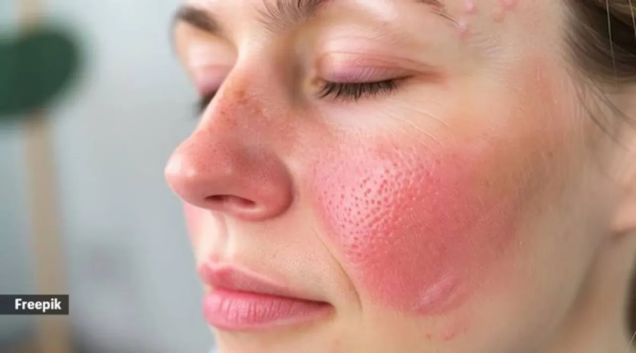 rosacea