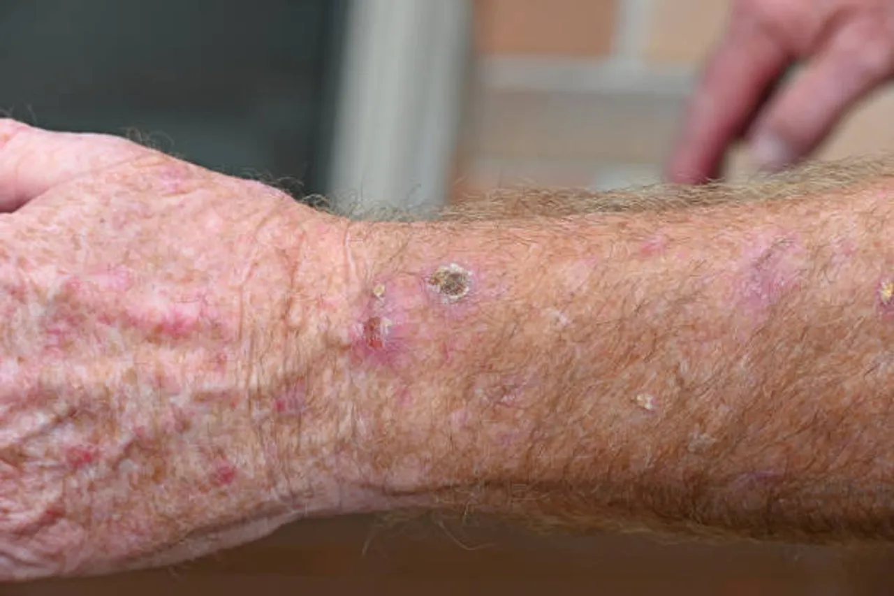 keratosis pilaris