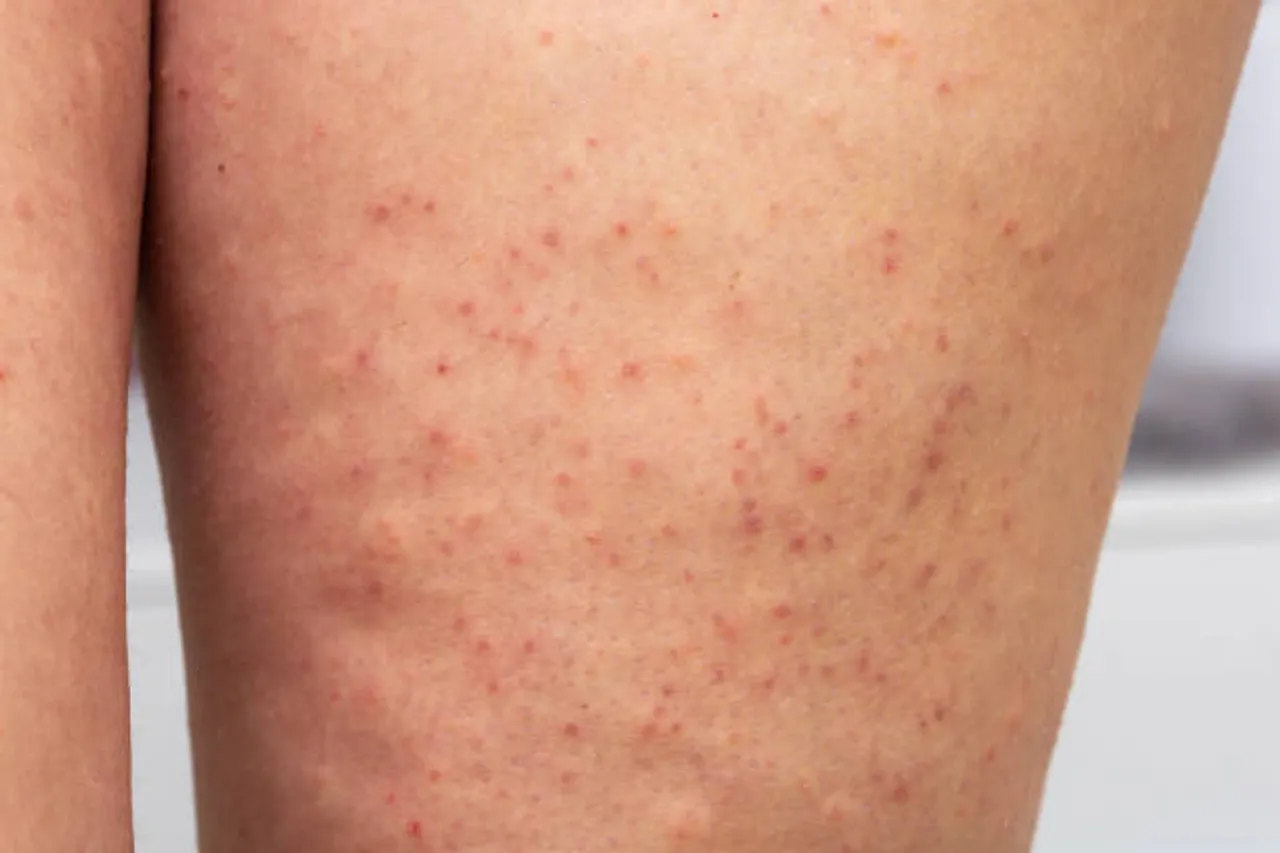 keratosis pilaris