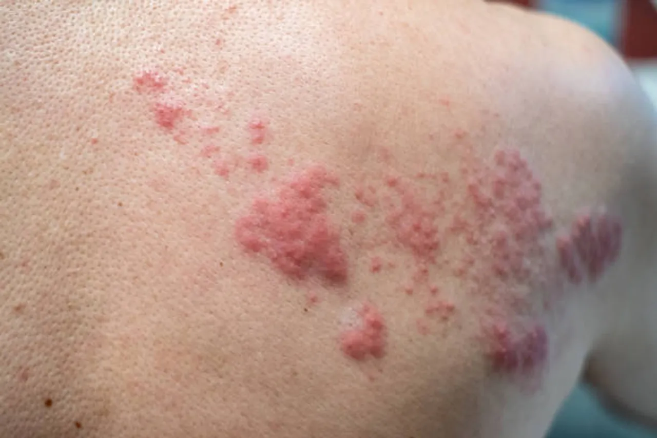 red bumps