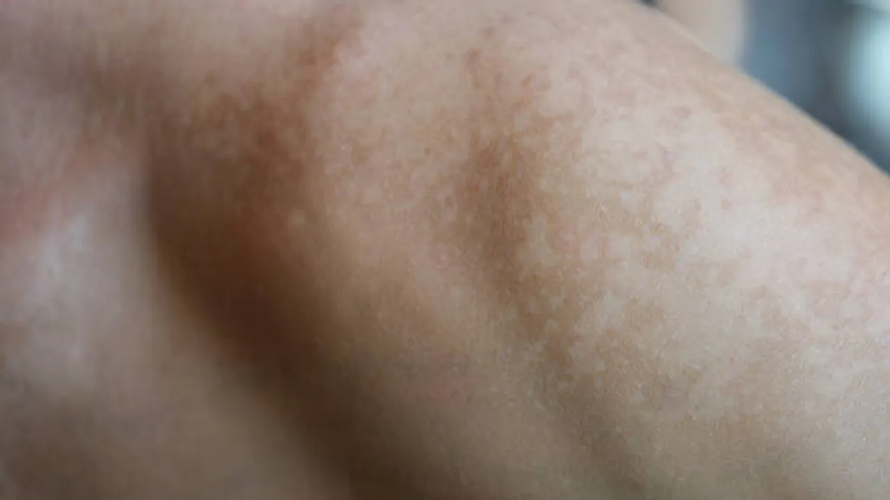 skin