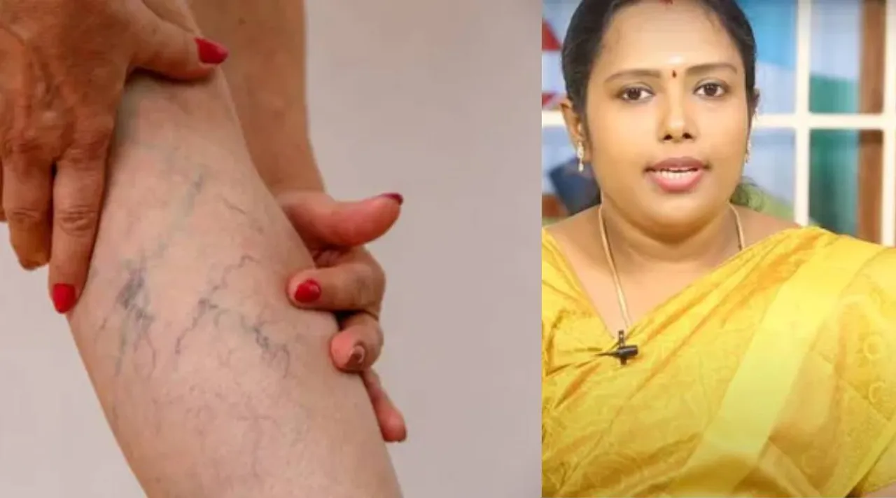 Varicose issue