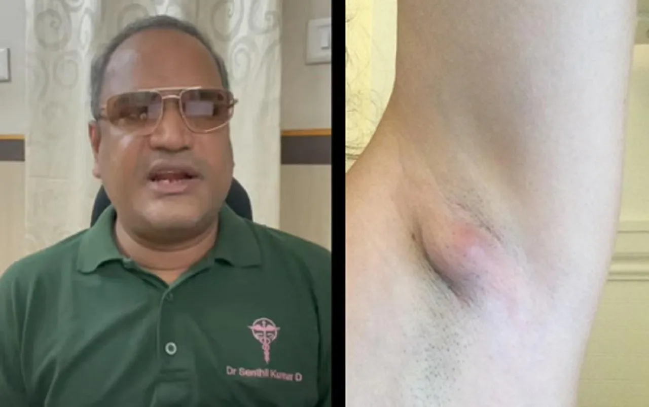 Underarm Abscess Dr Senthilkumar