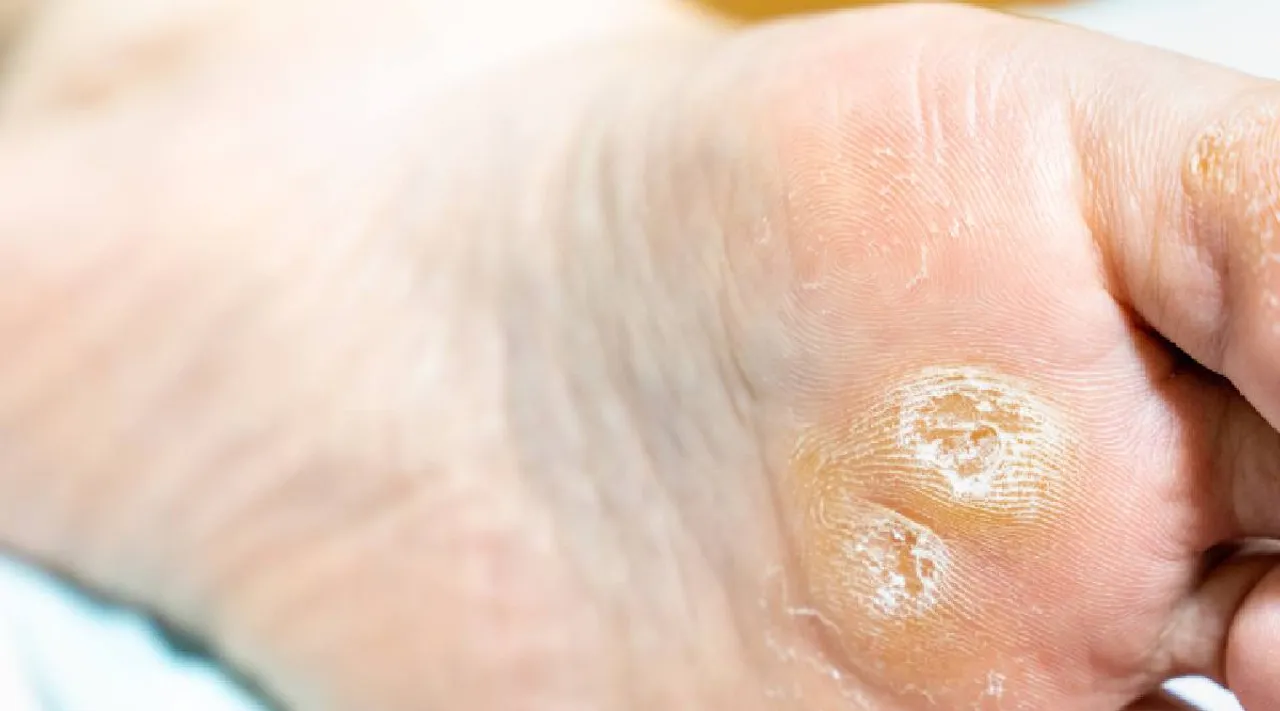 foot corns 2