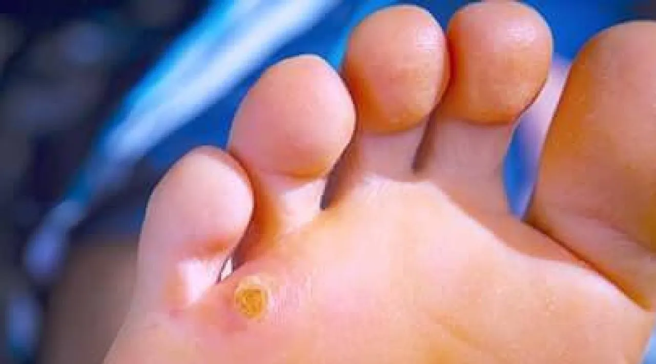 foot corns 5