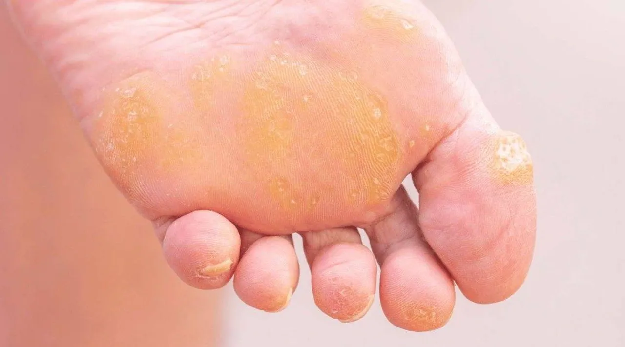foot corns 1