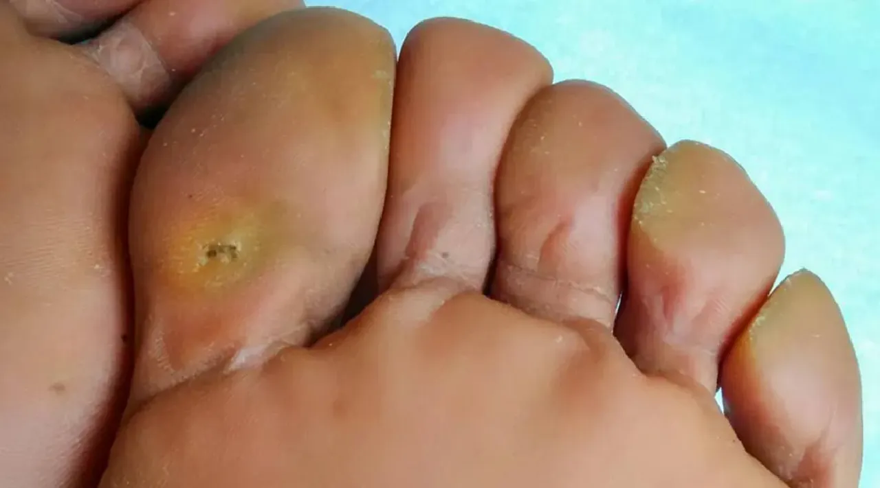 foot corns 3
