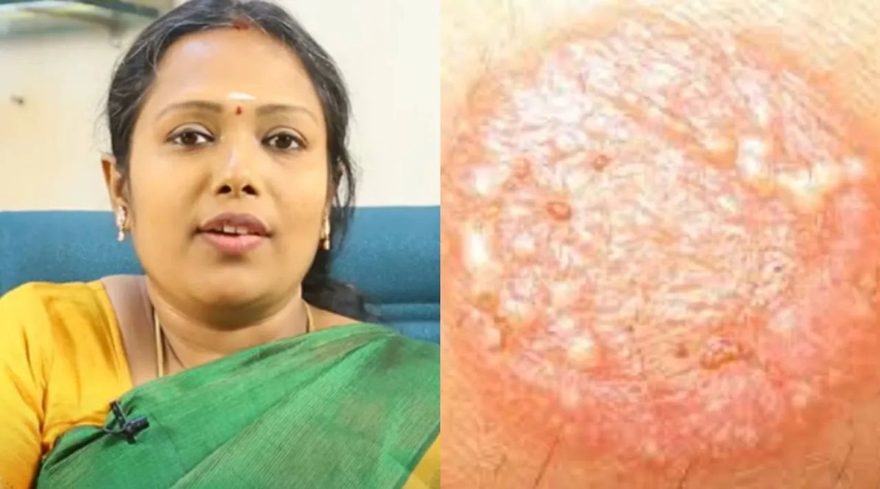 rajalakshmi ringworm