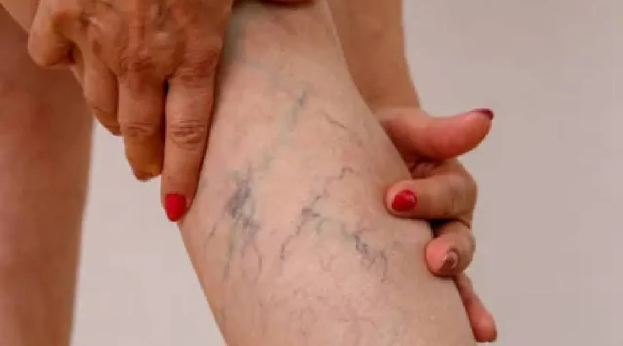 Vein 1