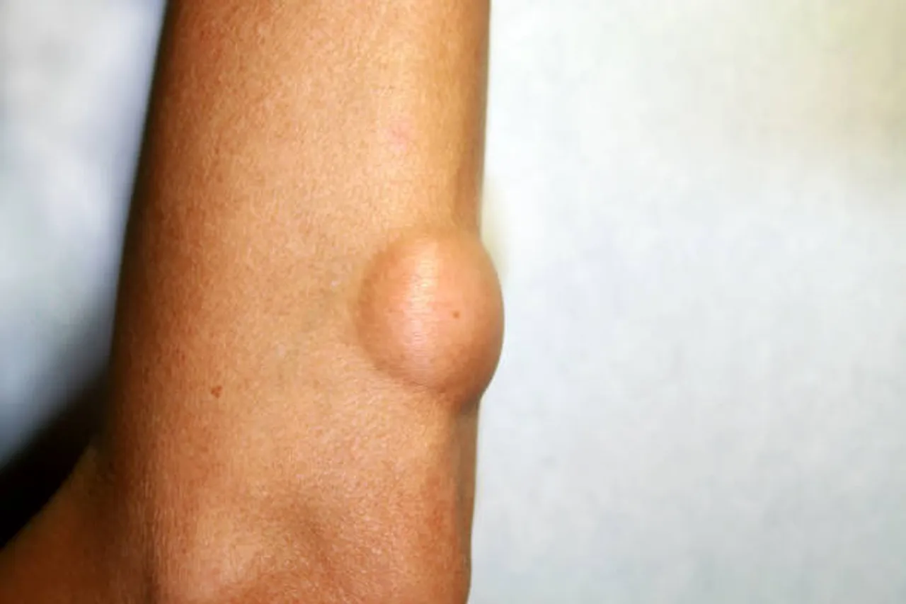 lipoma