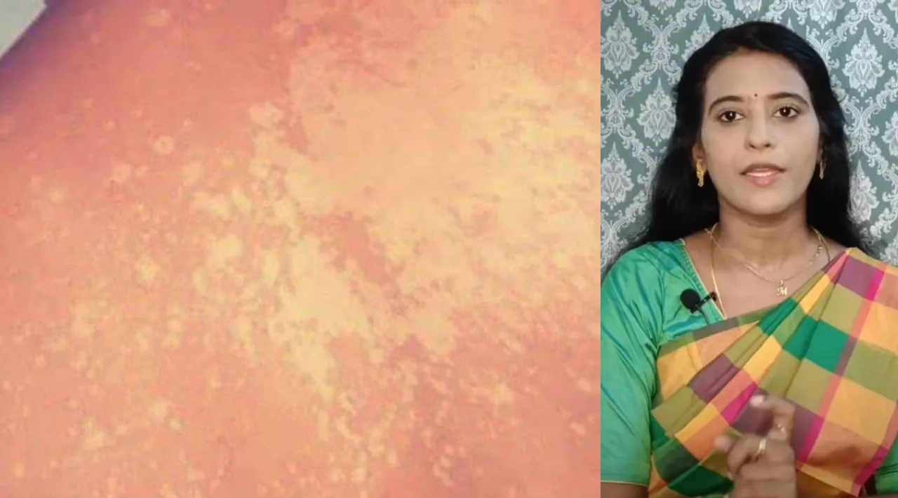 Home remedy for skin diseasect