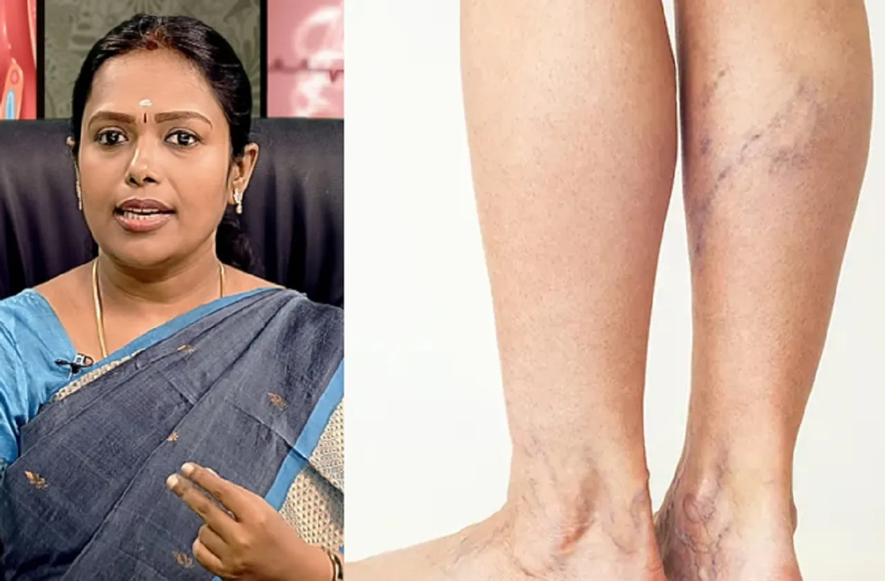 Varicose veins home remedies