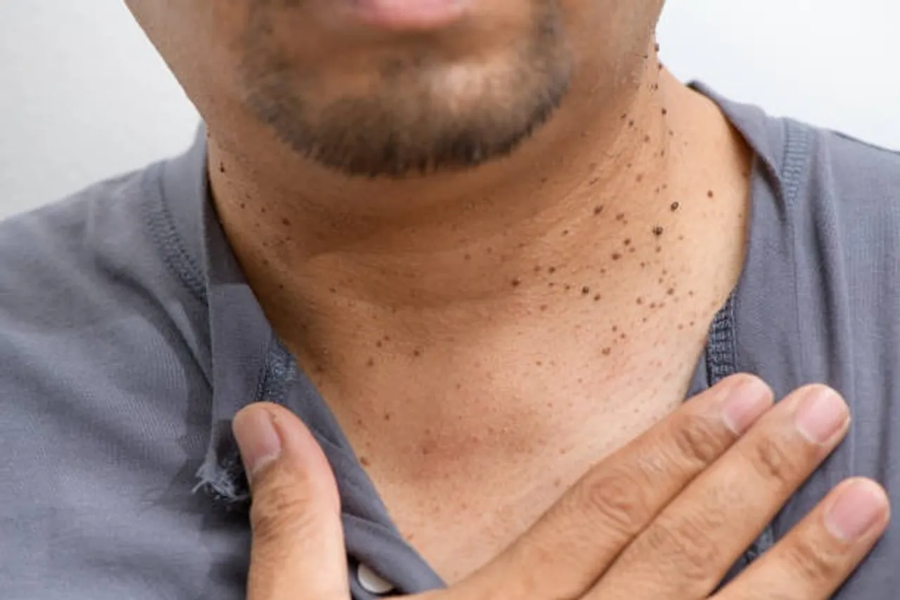 skin tag