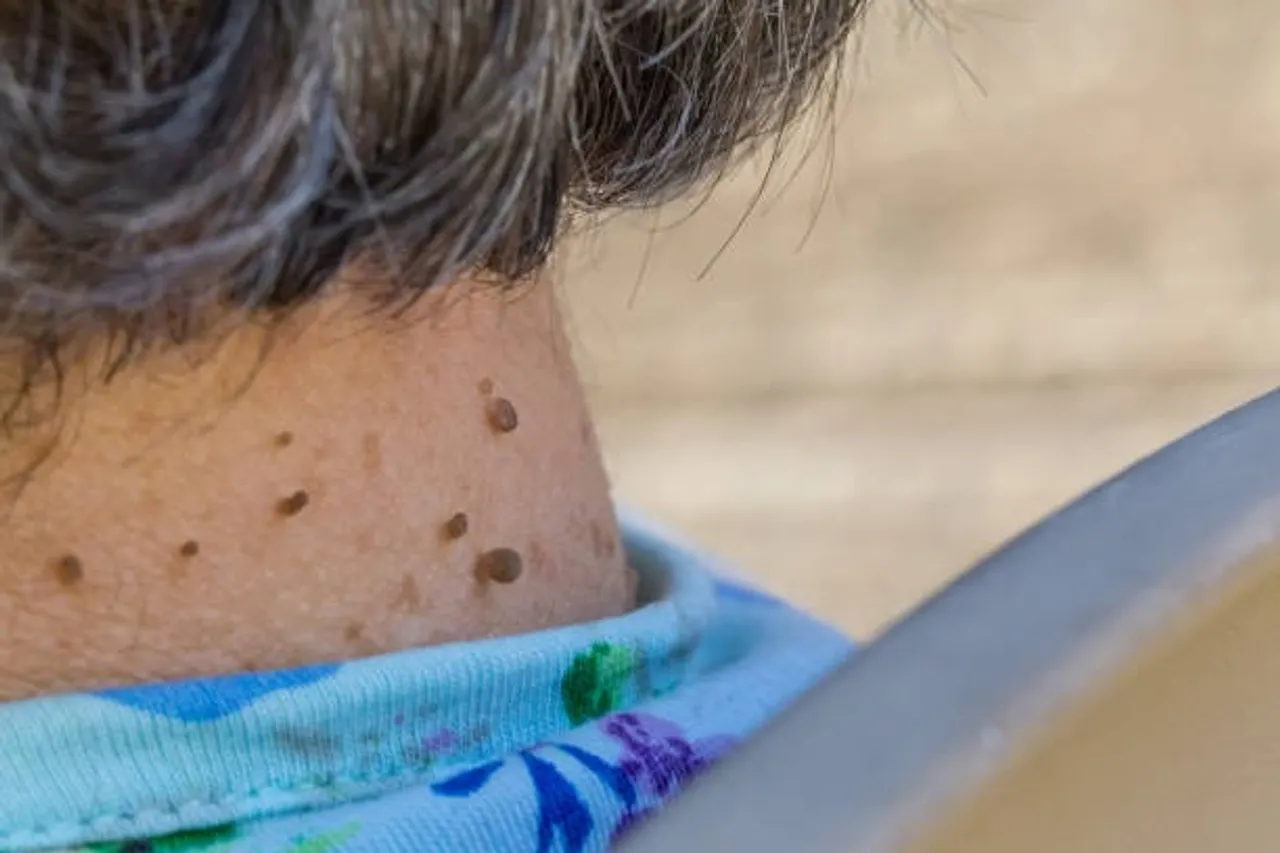 skin tag
