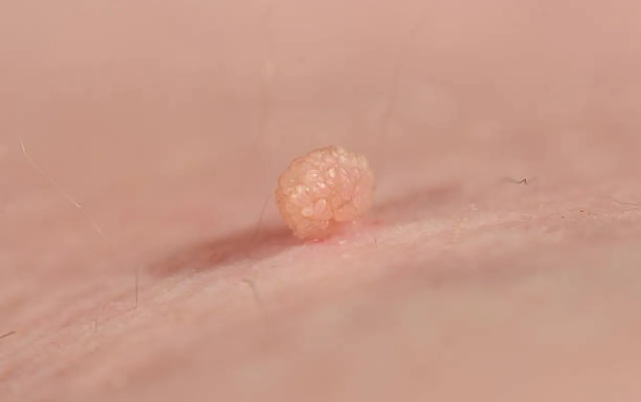 skin tag