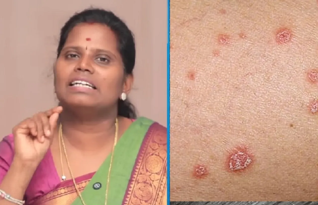 Psoriasis natural Home remedies
