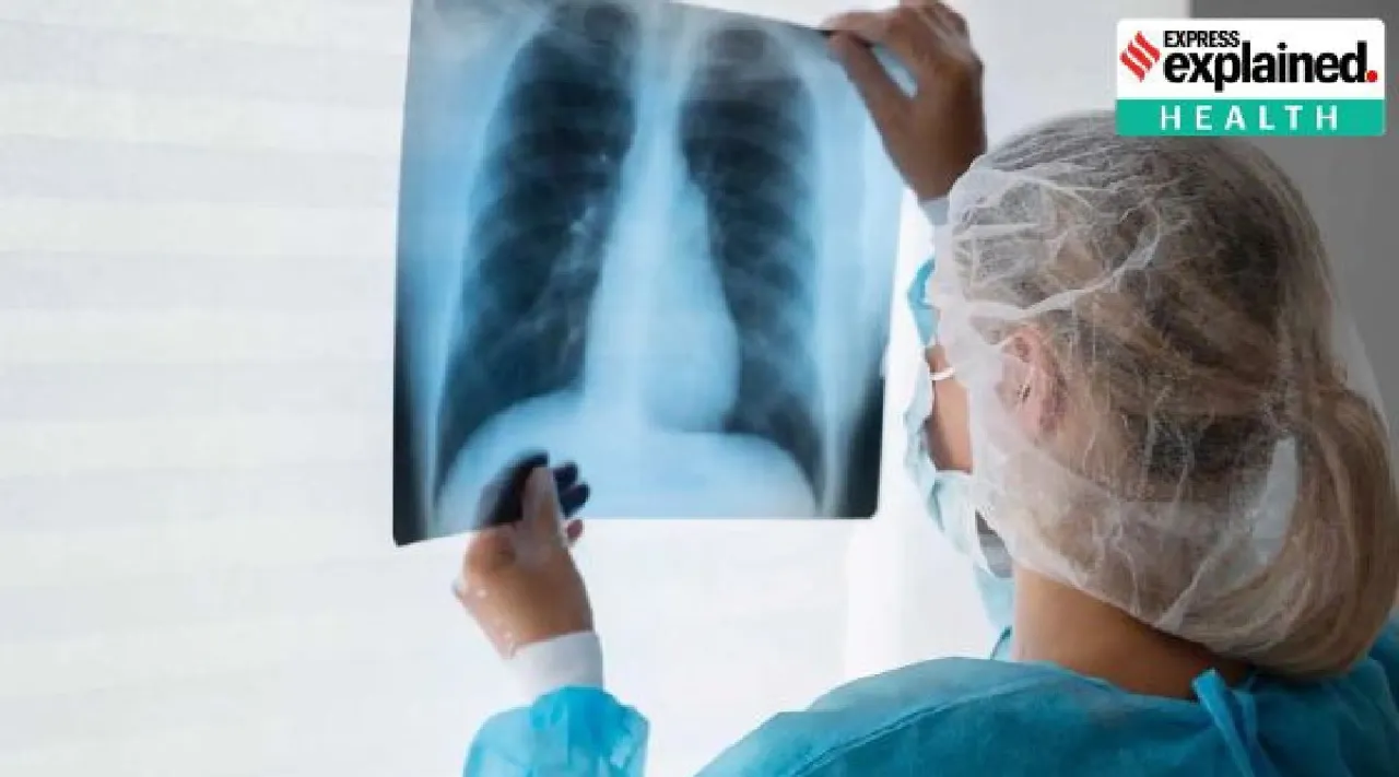 How novel initiative helped Tamil Nadu bring down TB deaths in the state Tamil News