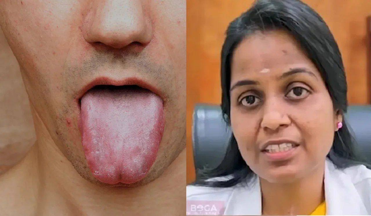 White tongue coating