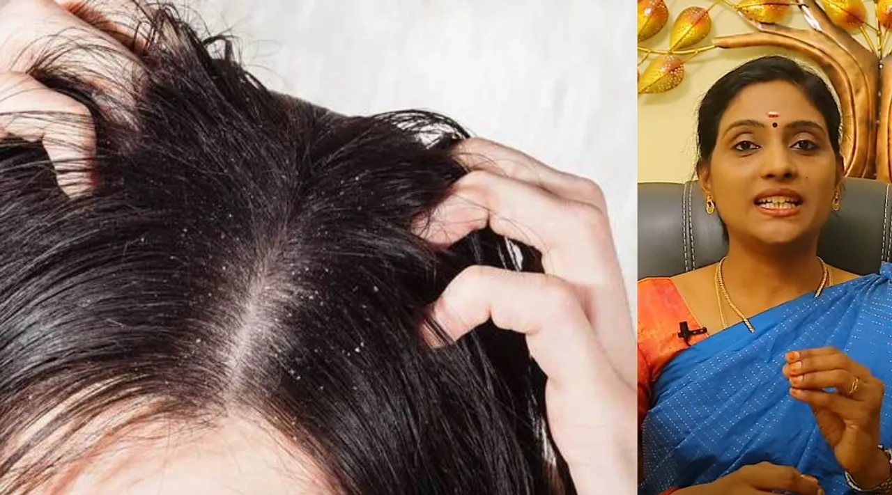dandruff