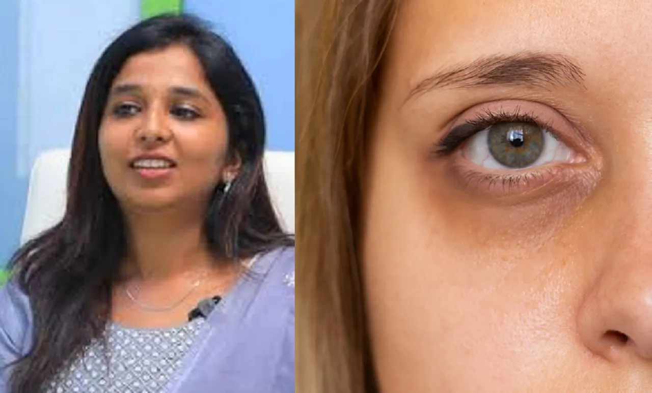 Dark circles Home remedies
