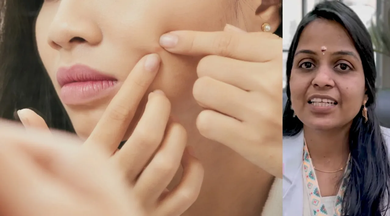pimples