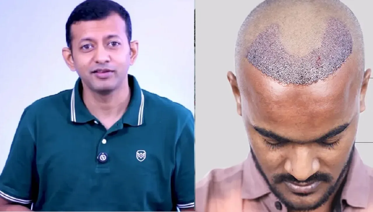 Hair fall Baldness