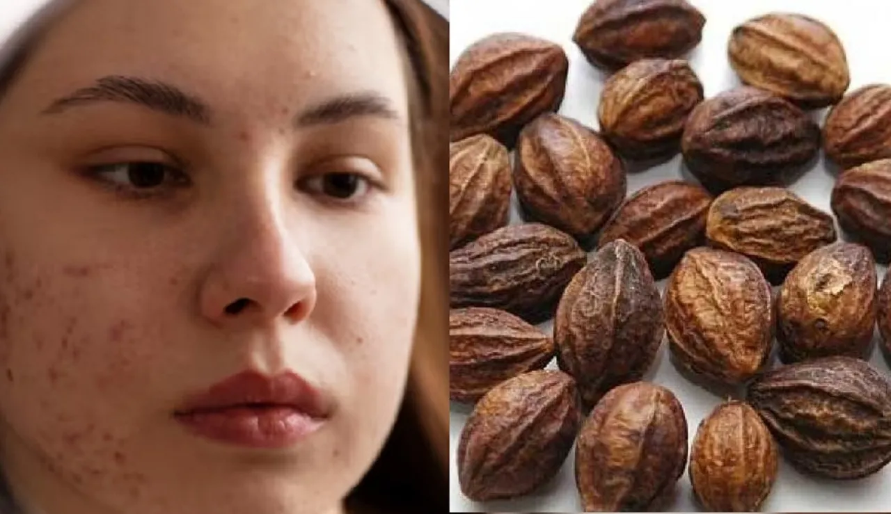 Acne mark home remedies