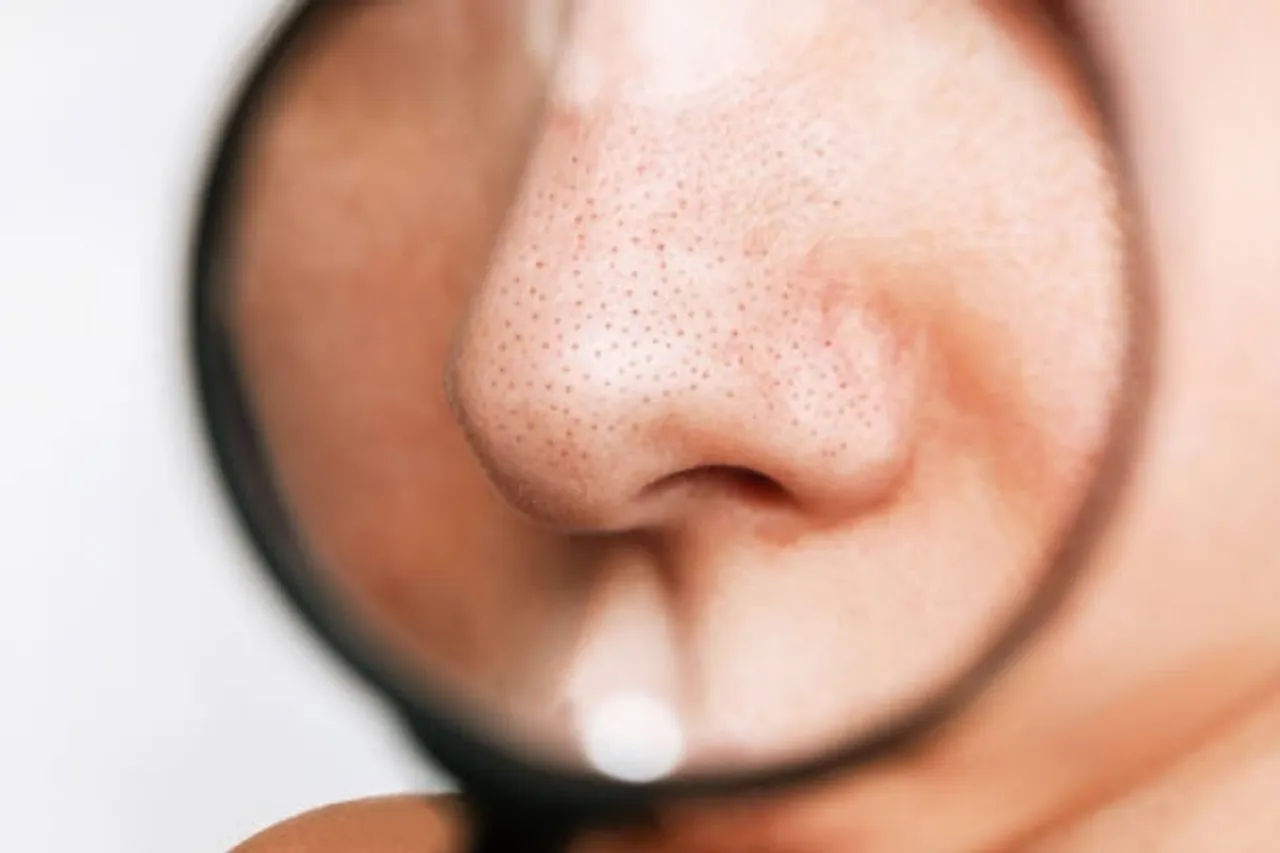 black heads