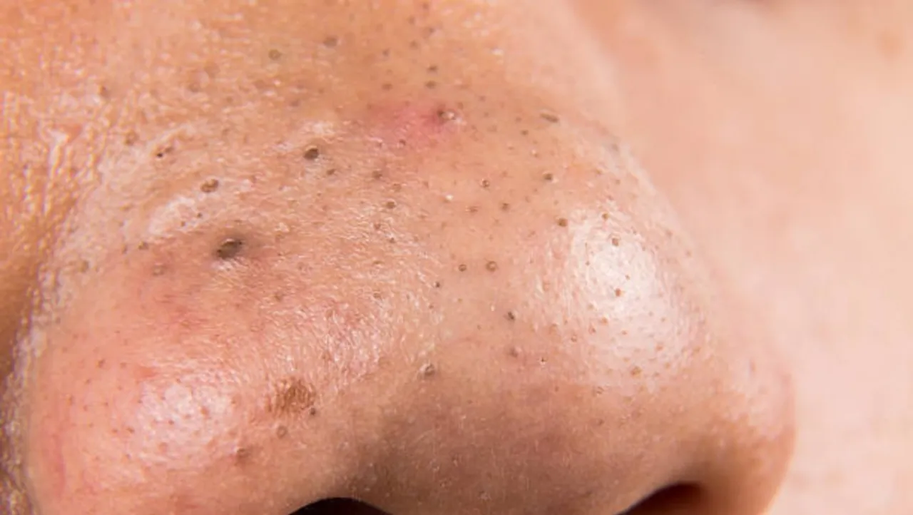 black heads