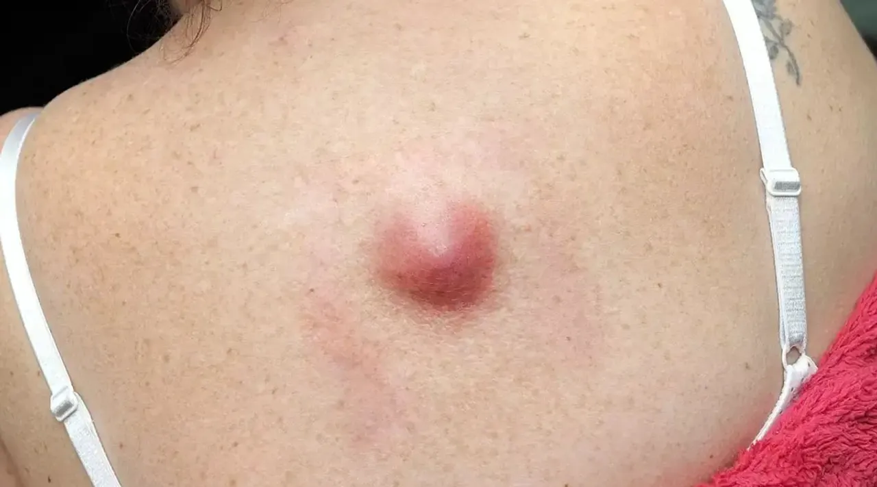lippomas
