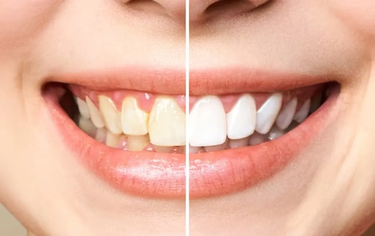 Teeth remedies