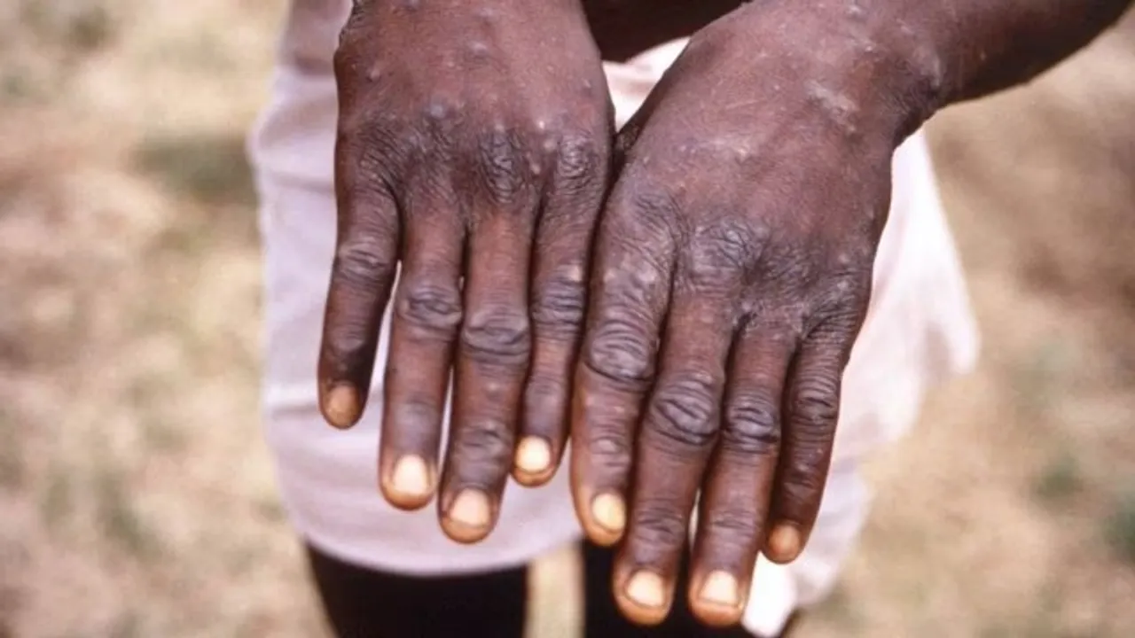 monkeypox vs smallpox vaccine