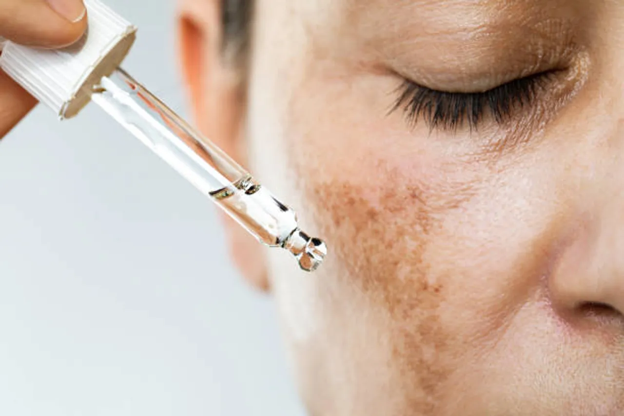 dark spots