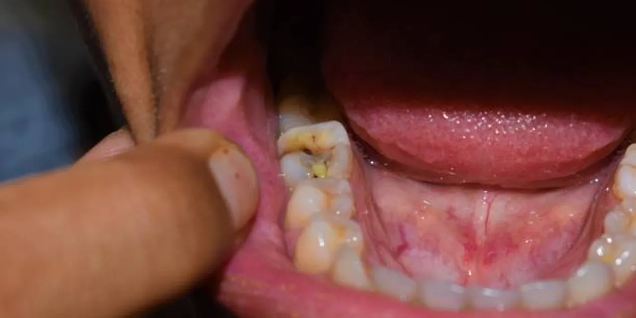 toothache