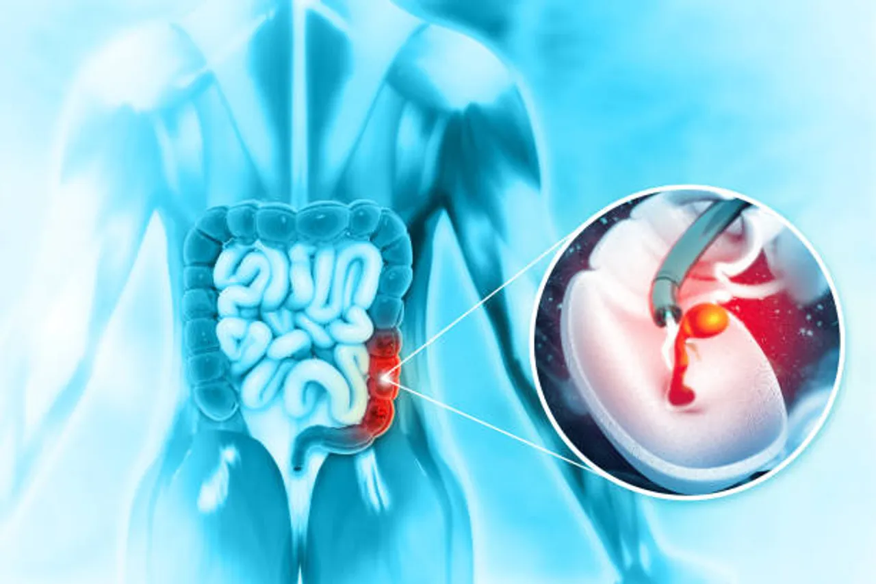 colon cancer